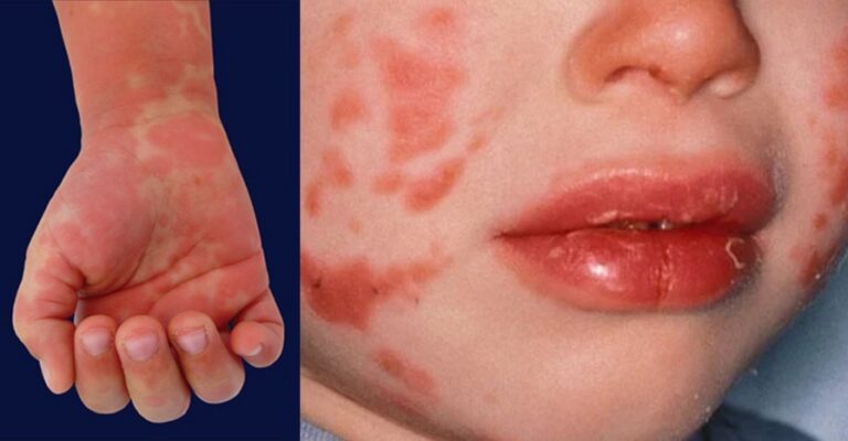 Kawasaki disease