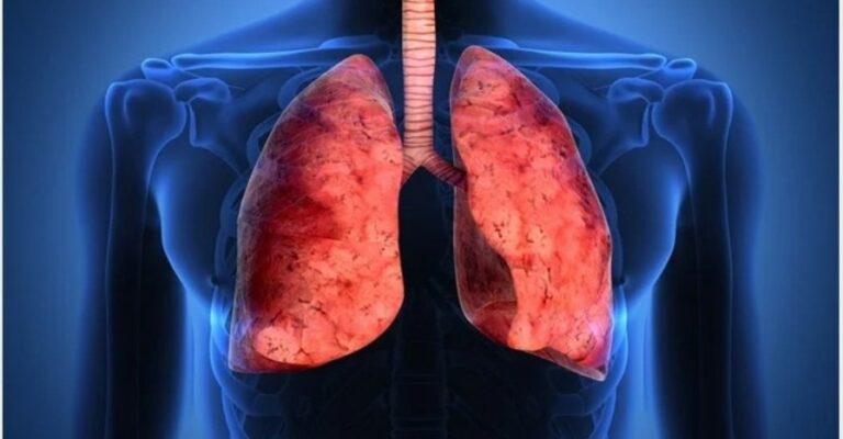 asthma