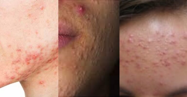 Acne Problems