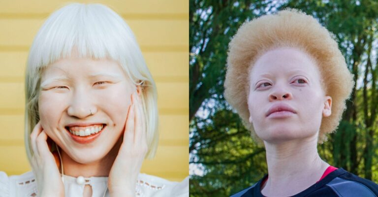 albino