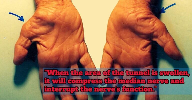 Carpal Tunnel Syndrome