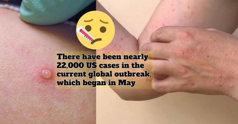 monkeypox death