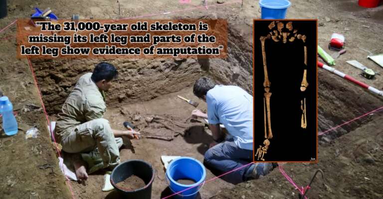 oldest amputation
