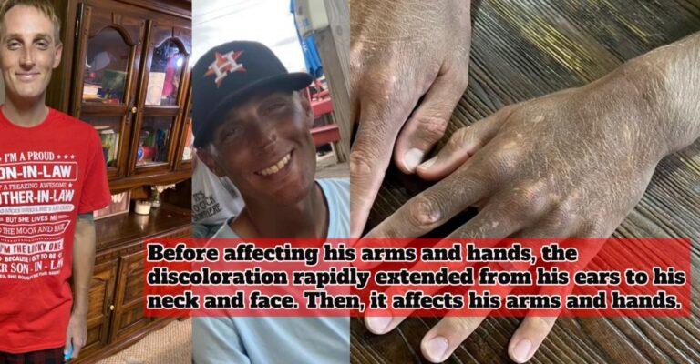 Man's Skin Mysteriously Changed
