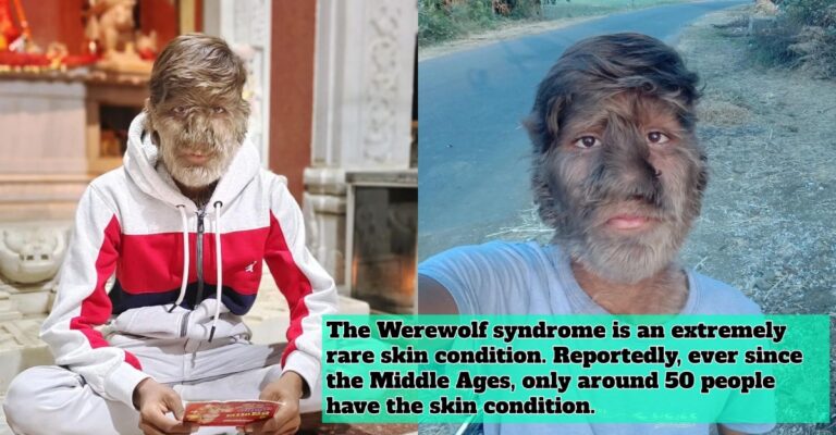 werewolf syndrome