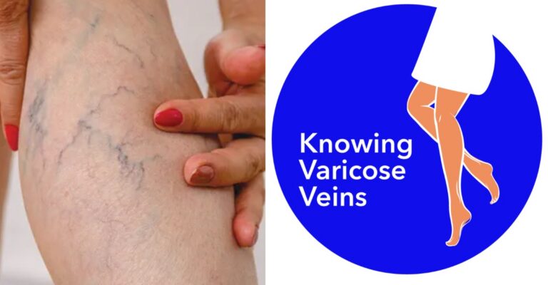 Varicose veins