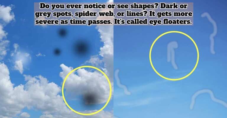eye floaters