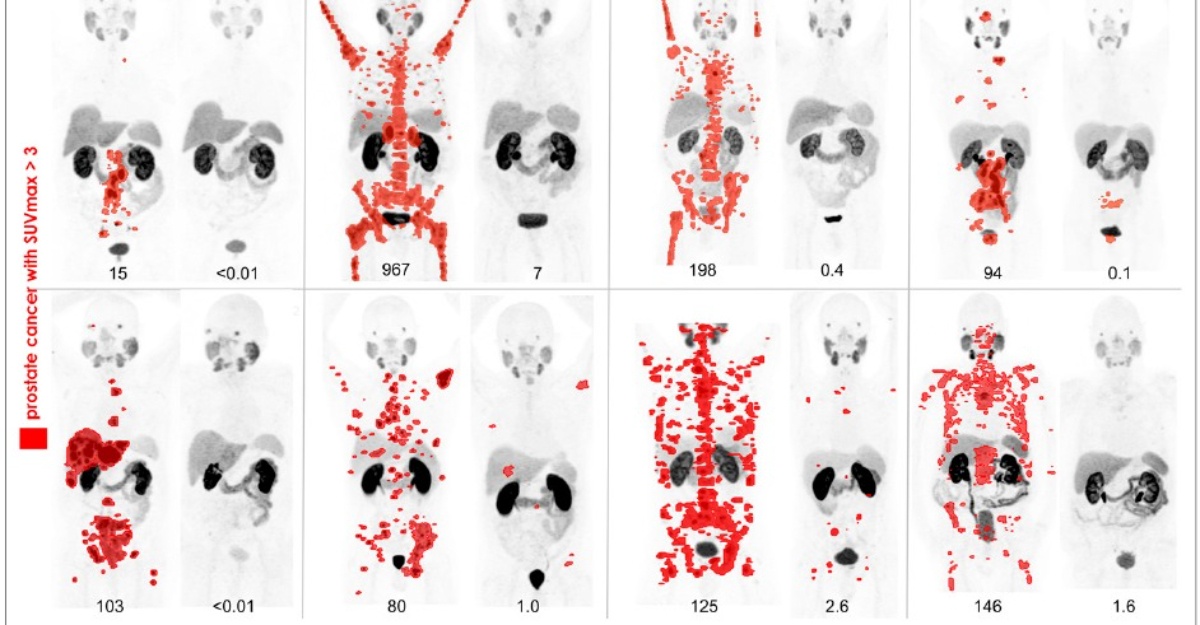 Prostate Cancer Breakthroughs with Nuclear Medicine