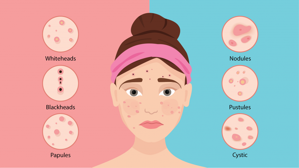 What Does Hormonal Acne Look Like 1024x576 1